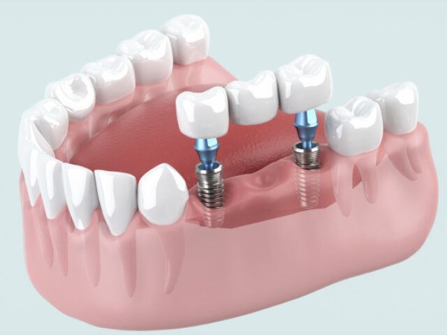ストローマン・インプラント