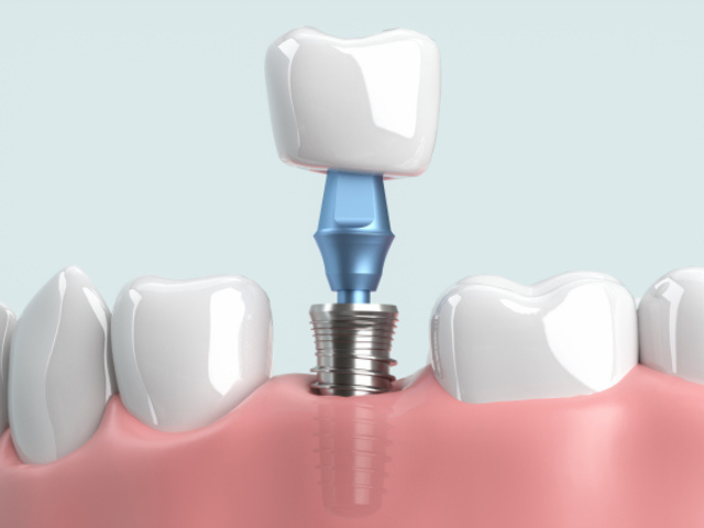 インプラント治療